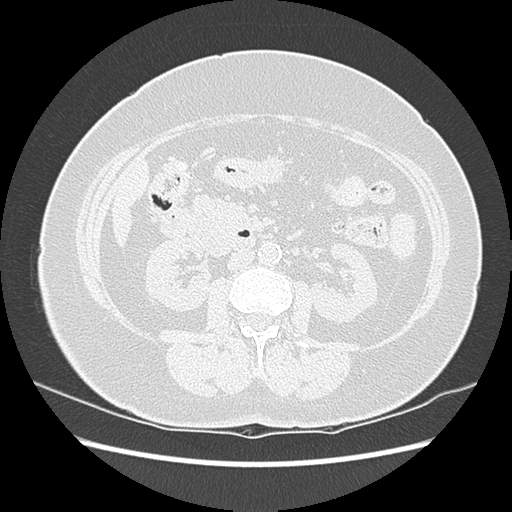 Adenocarcinoma in situ of lung (Radiopaedia 38685-40829 B 266).png
