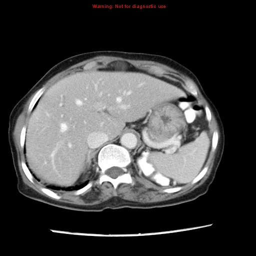 Adenocarcinoma of the colon (Radiopaedia 8191-9039 Axial liver window 16).jpg