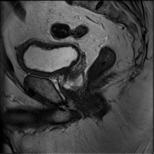 File:Adenocarcioma of rectum- T1 lesion (Radiopaedia 36921-38546 Sagittal T2 14).png