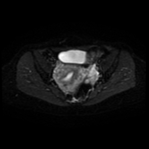 Adenoma malignum of cervix (Radiopaedia 66441-75705 Axial DWI 9).jpg