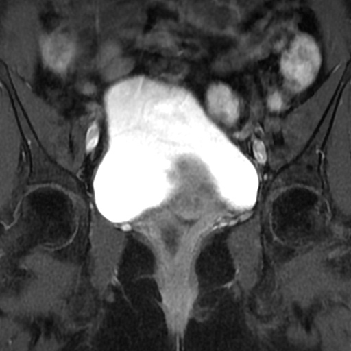 File:Adenoma malignum of cervix (Radiopaedia 66441-75705 Coronal T1 C+ fat sat 6).jpg