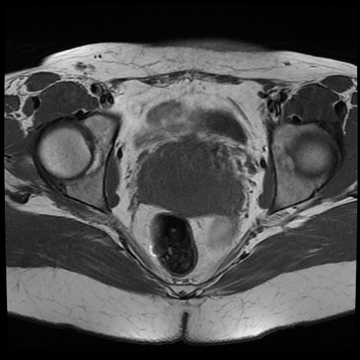 File:Adenomyosis-scar endometriosis (Radiopaedia 65863-75022 Axial T1 21).jpg