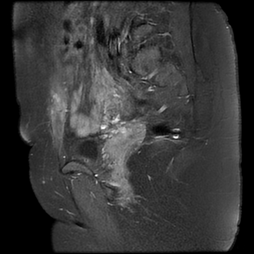 File:Adenomyosis-scar endometriosis (Radiopaedia 65863-75022 Sagittal T1 C+ fat sat 8).jpg