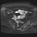 File:Adenomyosis and endometriotic cysts (Radiopaedia 82300-96367 Axial DWI 15).jpg