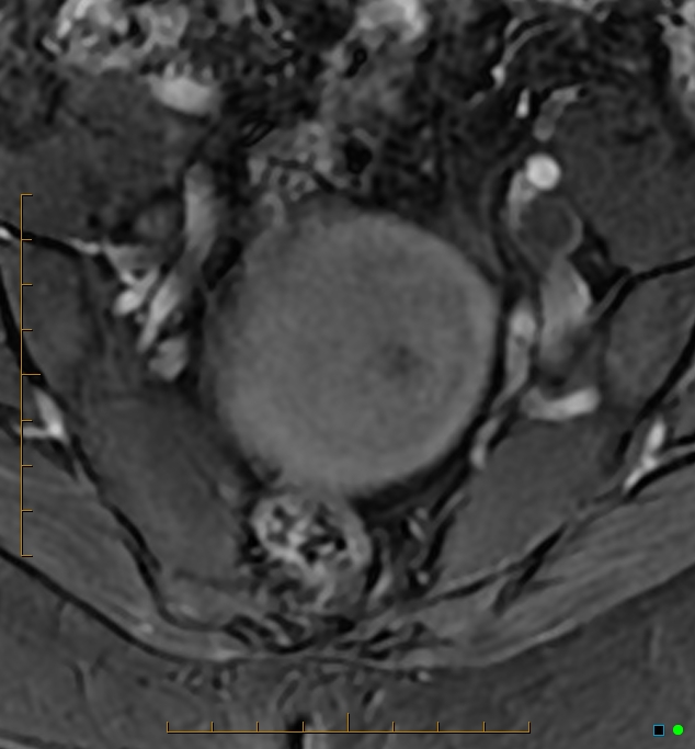Adenomyosis uterus with hematometra (Radiopaedia 45779-50011 Axial T1 C+ fat sat 7).jpg