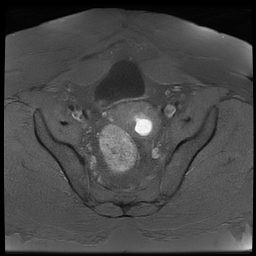 File:Adenomyosis within a didelphys uterus (Radiopaedia 70175-80215 Axial T1 fat sat 24).jpg