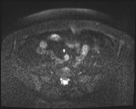Adnexal multilocular cyst (O-RADS US 3- O-RADS MRI 3) (Radiopaedia 87426-103754 Axial DWI 32).jpg