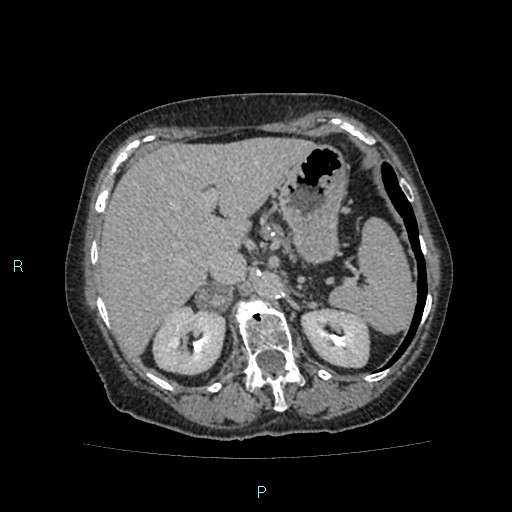 File:Adrenal collision tumor (ACT) (Radiopaedia 48462-53379 Axial C+ delayed 17).jpg