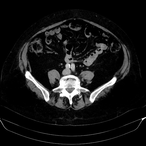 Adrenal cortical carcinoma (Radiopaedia 64017-72769 Axial C+ portal venous phase 47).jpg