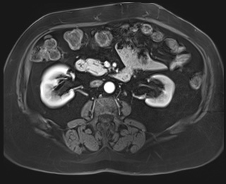 Adrenal cortical carcinoma (Radiopaedia 64017-72770 I 49).jpg