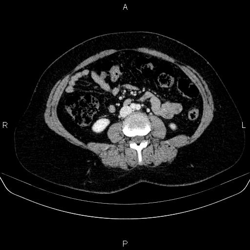 Adrenal cortical carcinoma (Radiopaedia 84882-100379 Axial C+ portal venous phase 49).jpg