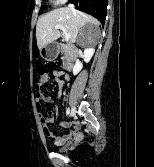 File:Adrenal cortical carcinoma (Radiopaedia 84882-100379 Sagittal C+ portal venous phase 35).jpg