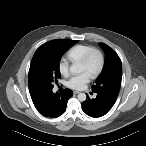 File:Adrenal cyst (Radiopaedia 45625-49777 Axial C+ portal venous phase 2).png