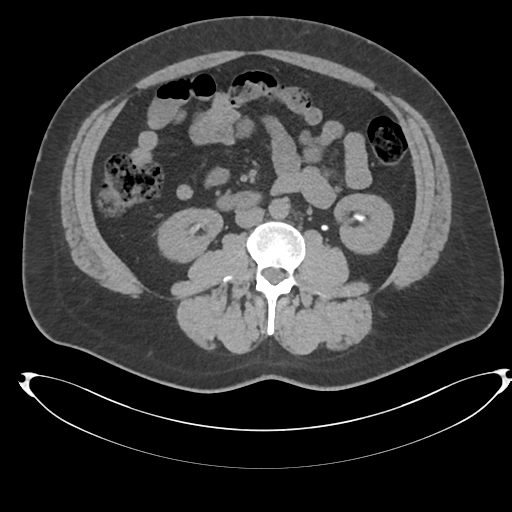 Adrenal cyst (Radiopaedia 45625-49778 Axial non-contrast 63).png