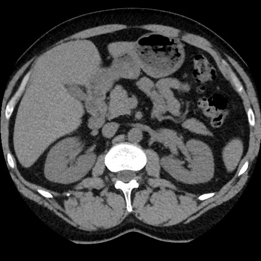 Adrenal gland trauma (Radiopaedia 81351-95079 Axial non-contrast 41).jpg