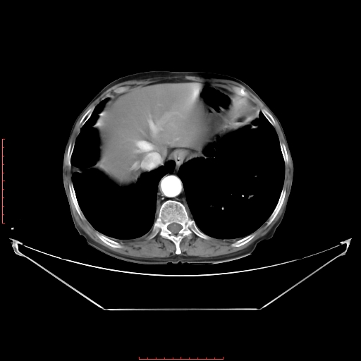 Adrenal hemangioma (Radiopaedia 68923-78668 Axial C+ arterial phase 18).jpg