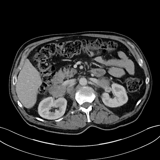 Adrenal lymphoma (Radiopaedia 73730-84529 Axial C+ portal venous phase 43).jpg