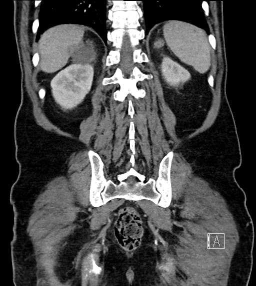 Adrenal lymphoma (Radiopaedia 73730-84529 Coronal C+ portal venous phase 65).jpg