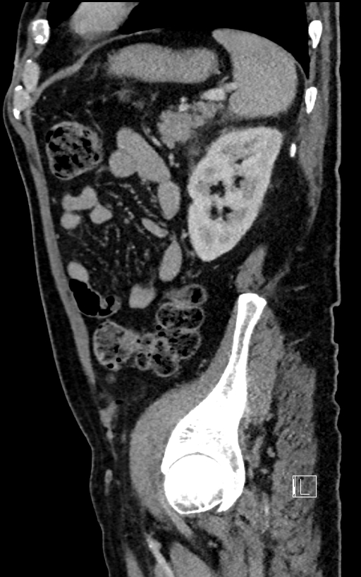 Adrenal lymphoma (Radiopaedia 73730-84529 Sagittal C+ portal venous phase 84).jpg