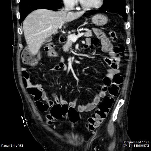 Adrenal metastasis (Radiopaedia 78425-91079 Sagittal C+ portal venous phase 21).jpg
