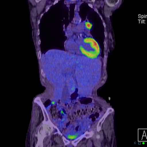 File:Adrenal metastasis from small cell lung cancer (Radiopaedia 19133-19109 Coronal 8).jpg