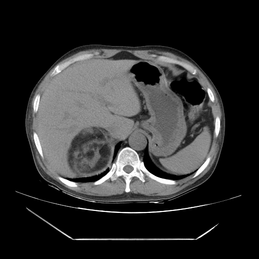 File:Adrenal myelolipoma (Radiopaedia 41843-44834 Axial non-contrast 10).jpg