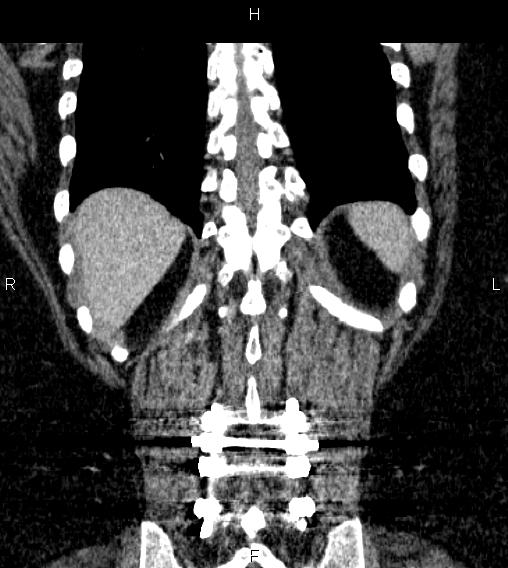 Adrenal myelolipoma (Radiopaedia 84319-99617 Coronal renal cortical phase 66).jpg