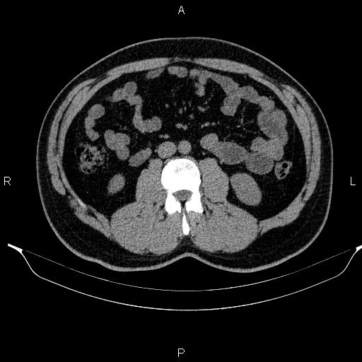 Adrenal myelolipoma (Radiopaedia 84321-99619 Axial non-contrast 58).jpg