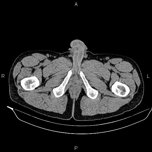 Adrenal myelolipoma (Radiopaedia 87794-104246 Axial non-contrast 116).jpg