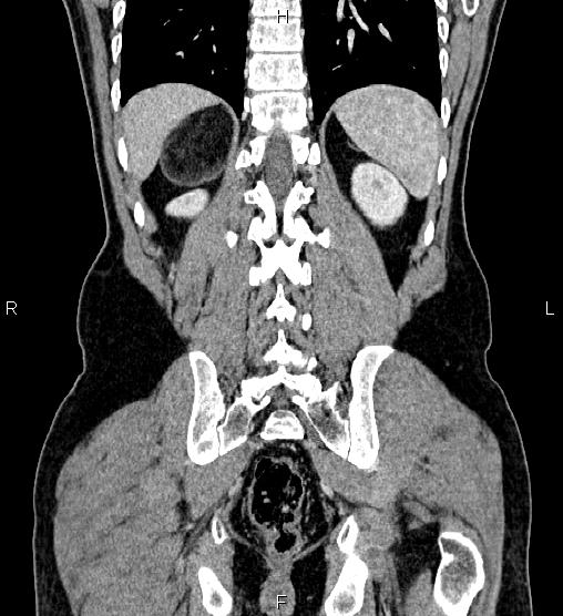Adrenal myelolipoma (Radiopaedia 87794-104246 Coronal renal cortical phase 52).jpg