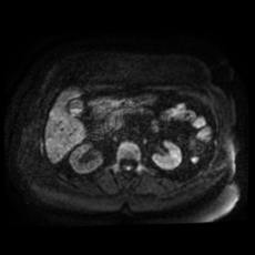 File:Adrenal myelolipoma - MRI (Radiopaedia 83249-97646 Axial DWI 16).jpg