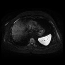 File:Adrenal myelolipoma - MRI (Radiopaedia 83249-97646 Axial DWI 3).jpg