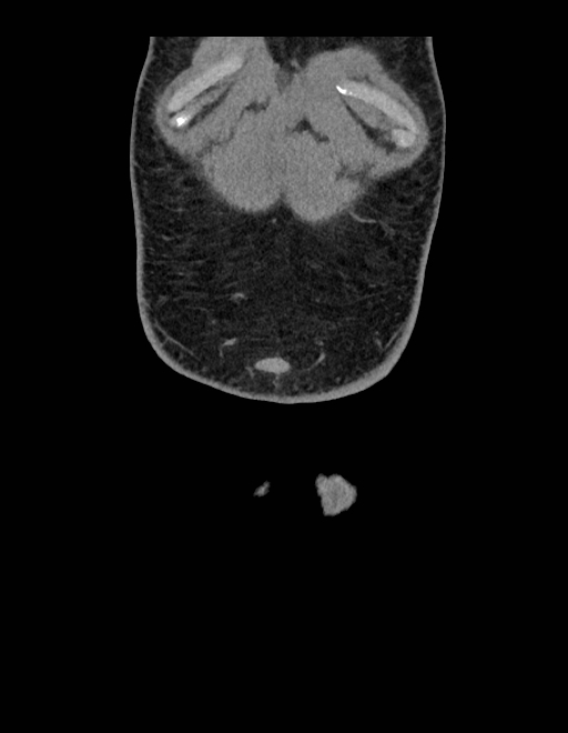 Adrenal myelolipoma - bilateral (Radiopaedia 74805-85810 Coronal C+ portal venous phase 254).jpg