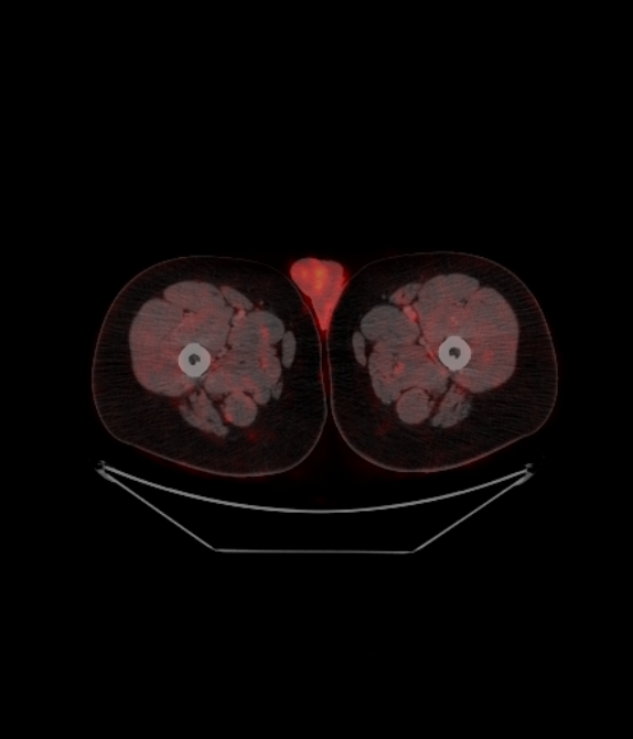 Adrenocortical carcinoma (Radiopaedia 80134-93440 ِAxial 289).jpg