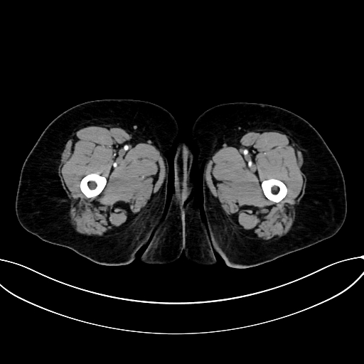 Adrenocortical carcinoma (Radiopaedia 87281-103569 Axial C+ arterial phase 100).jpg