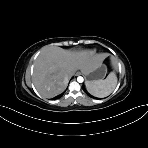 Adrenocortical carcinoma (Radiopaedia 87281-103569 Axial C+ arterial phase 15).jpg