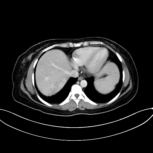 Adrenocortical carcinoma (Radiopaedia 87281-103569 Axial C+ portal venous phase 12).jpg