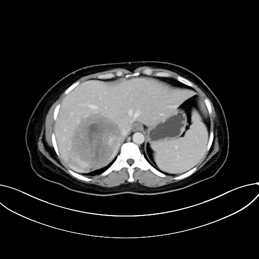 Adrenocortical carcinoma (Radiopaedia 87281-103569 Axial C+ portal venous phase 17).jpg