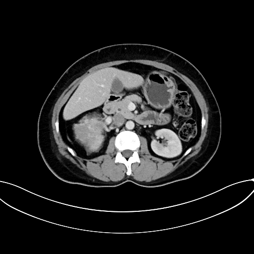 Adrenocortical carcinoma (Radiopaedia 87281-103569 Axial C+ portal venous phase 37).jpg