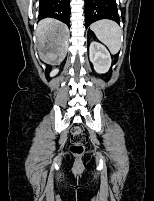 Adrenocortical carcinoma (Radiopaedia 87281-103569 Coronal C+ portal venous phase 108).jpg