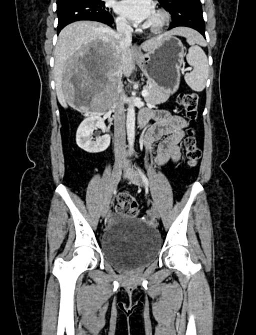 Adrenocortical carcinoma (Radiopaedia 87281-103569 Coronal C+ portal venous phase 48).jpg
