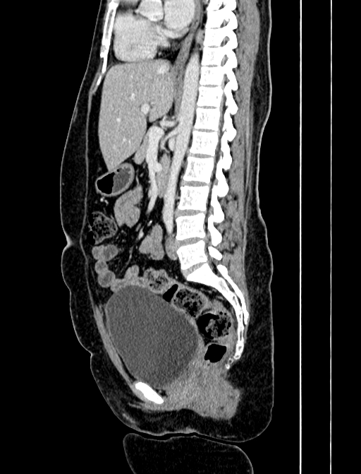 Adrenocortical carcinoma (Radiopaedia 87281-103569 Sagittal C+ portal venous phase 158).jpg