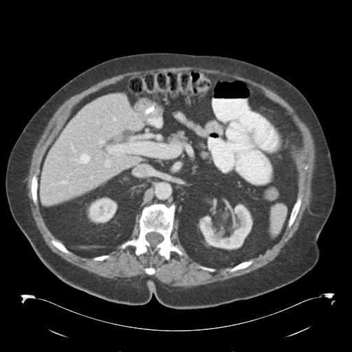 Adult ileal intussusception with secondary obstruction (Radiopaedia 30395-31051 Axial C+ portal venous phase 24).jpg