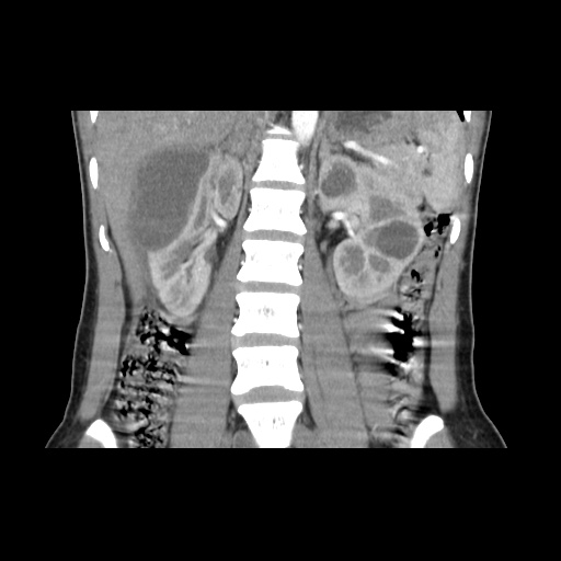 File:Adult polycystic kidney disease (Radiopaedia 48845-53876 Coronal renal cortical phase 22).jpg