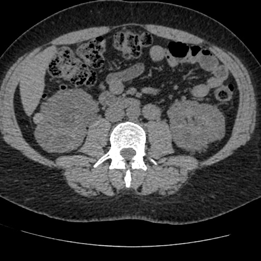 Adult polycystic kidney disease (Radiopaedia 59075-66368 Axial non-contrast 44).jpg