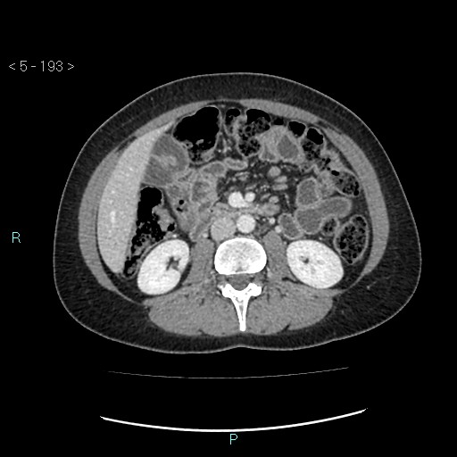 File:Adult transient intestinal intussusception (Radiopaedia 34853-36310 Axial C+ portal venous phase 33).jpg