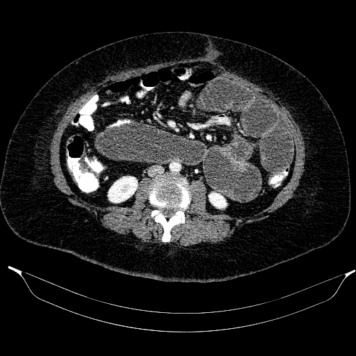 Afferent loop syndrome - secondary to incarcerated trocar site hernia (Radiopaedia 82959-97305 Axial C+ portal venous phase 121).jpg