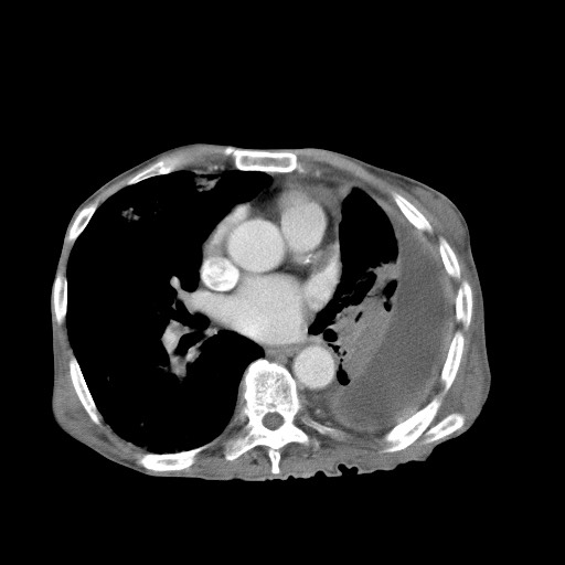 Aggressive lung cancer with cardiac metastases, pulmonary artery tumor thrombus, and Budd-Chiari (Radiopaedia 60320-67981 A 32).jpg