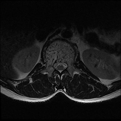 File:Aggressive vertebral hemangioma with pathological fracture (Radiopaedia 69528-79411 Axial T2 16).jpg