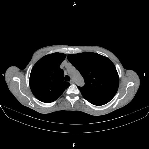 File:Air bronchogram in pneumonia (Radiopaedia 85719-101512 Axial non-contrast 19).jpg